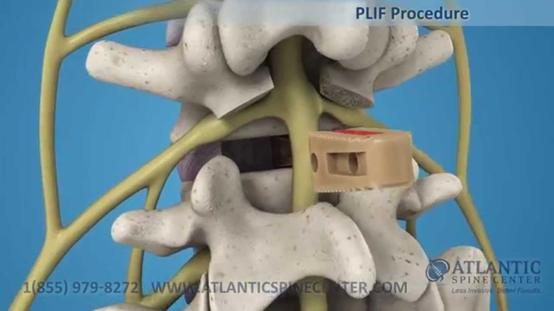 Posterior Lumbar Interbody Fusion