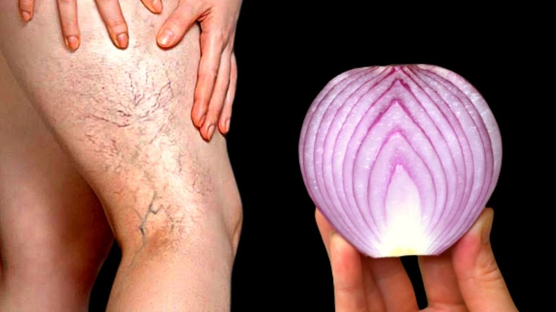 Incredible This is a varicose veins killer Erases varicose veins like a