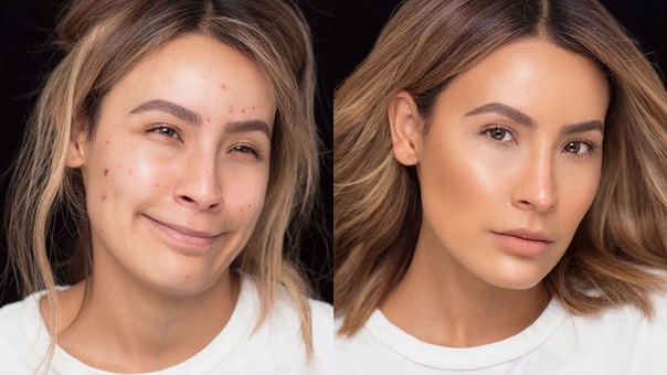 FLAWLESS SKIN WITH ACNE BREAKOUTS, DESI