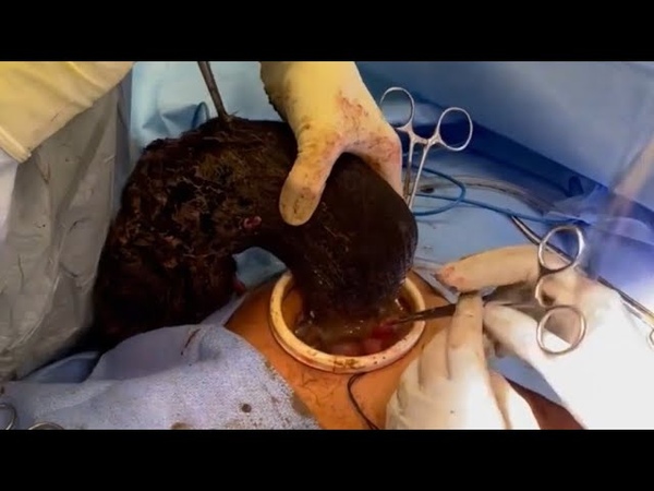 Open Removal Of Massive Trichobezoar In A Patient With Rapunzel Syndrome, Surgery,